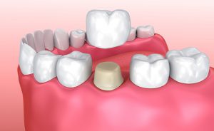 Dental crown placed over a prepared tooth