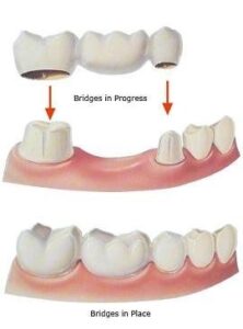 Dental bridge in progress and in place
