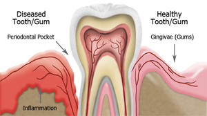 Gum treatment