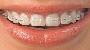 Clear aligners