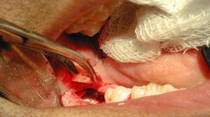 Oral surgery