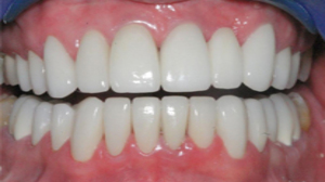 Smile designing