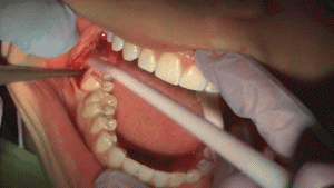 Dentist examining wisdom teeth